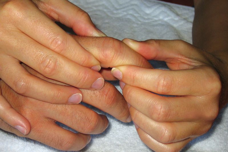 Handtherapie in der Erghotherapie